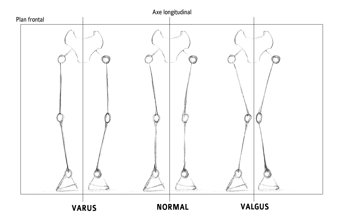 Over Pronation